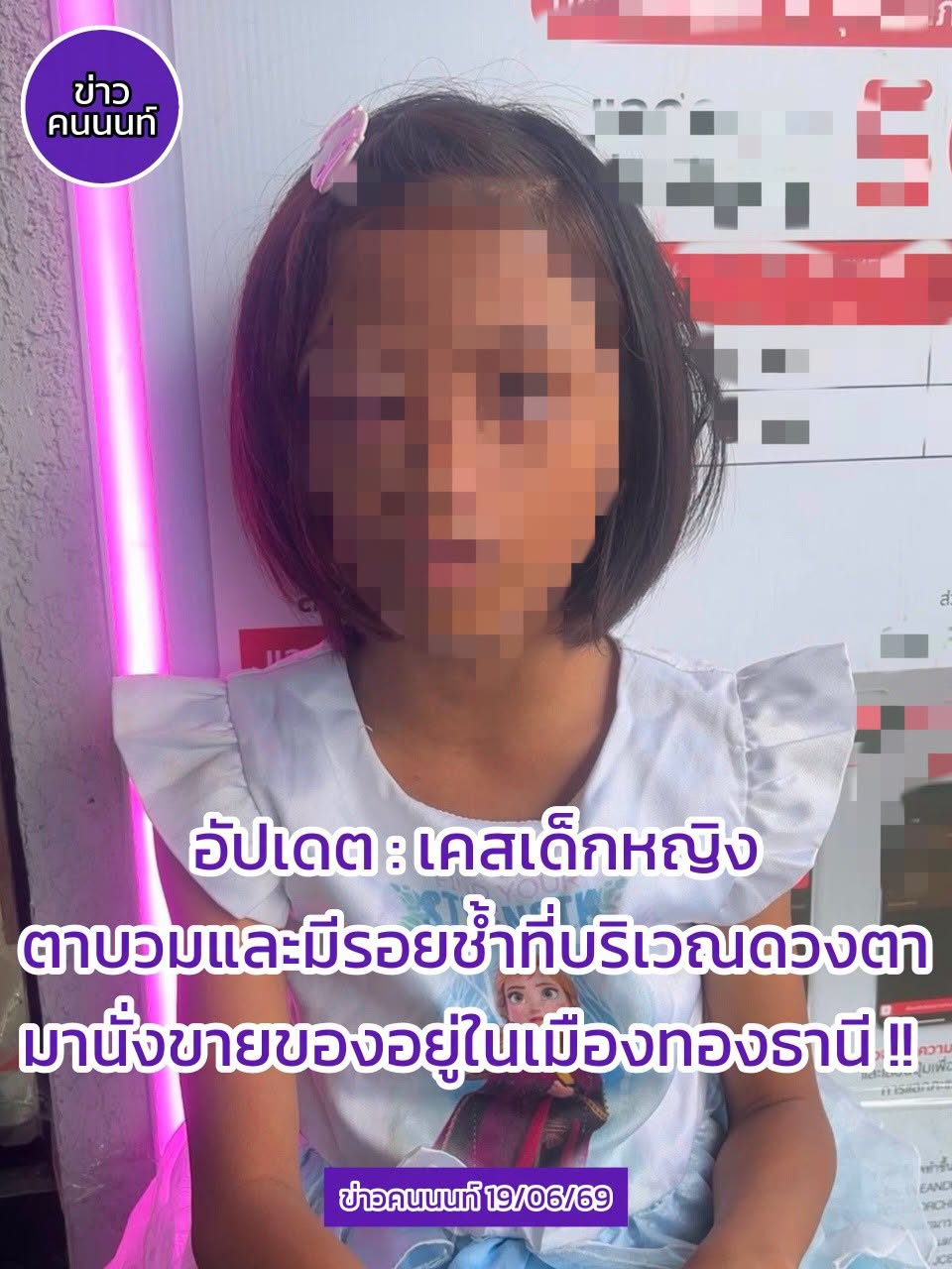 อัปเดต : เคสเด็กหญิงตาบวมและมีรอยช้ำที่บริเวณดวงตามานั่งขายของอยู่ในเมืองทองธานี